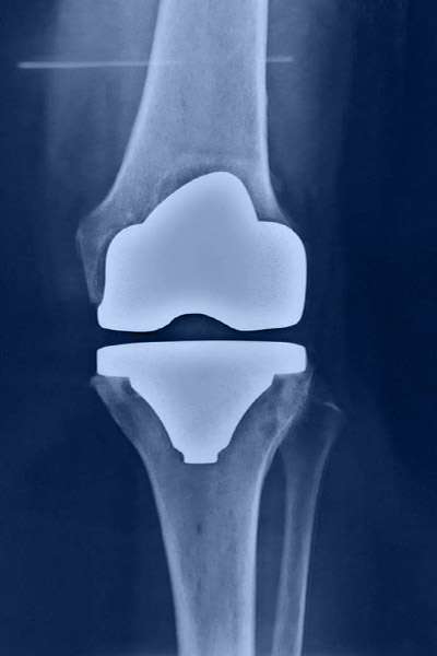 οστεοαρθρίτιδα γόνατος  3